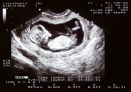 2D echo of a baby in a womb, 12 weeks and 5 days old.
