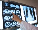 A doctor shows a picture of patients lungs from an x-ray.