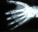 Hand x-ray photo.